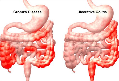 crohns-disease-s5-illustration-of-crohns-disease-and-ulcerative-colitis